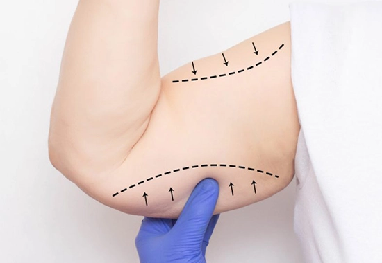 Les Avantages du Lifting Bras en Tunisie